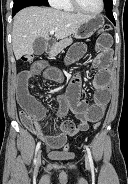 Adhesional small bowel obstruction (Radiopaedia 58900-66131 Coronal C+ portal venous phase 114).jpg