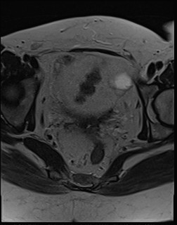 File:Adnexal multilocular cyst (O-RADS US 3- O-RADS MRI 3) (Radiopaedia 87426-103754 Axial T2 16).jpg