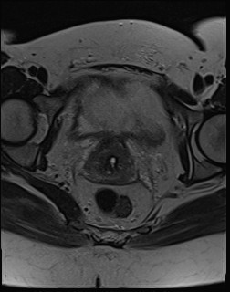 File:Adnexal multilocular cyst (O-RADS US 3- O-RADS MRI 3) (Radiopaedia 87426-103754 Axial T2 18).jpg