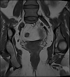 File:Adnexal multilocular cyst (O-RADS US 3- O-RADS MRI 3) (Radiopaedia 87426-103754 Coronal 20).jpg