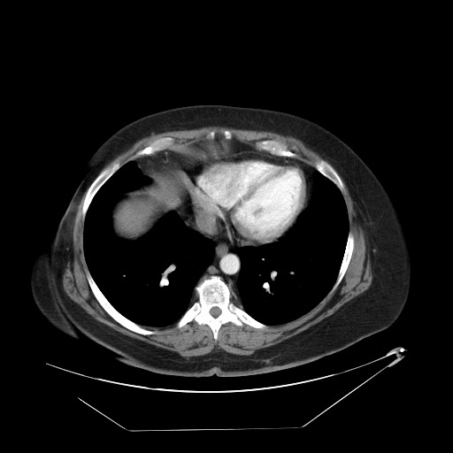 Adrenal angiosarcoma (Radiopaedia 81081-94671 Axial C+ arterial phase 4).jpg