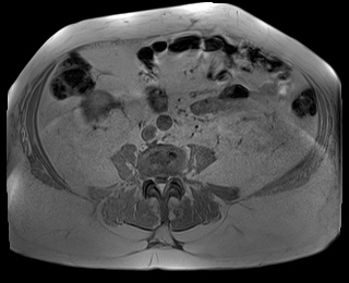 File:Adrenal cortical carcinoma (Radiopaedia 64017-72770 Axial T1 in-phase 62).jpg