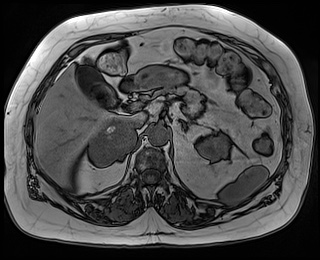File:Adrenal cortical carcinoma (Radiopaedia 64017-72770 Axial T1 out-of-phase 26).jpg
