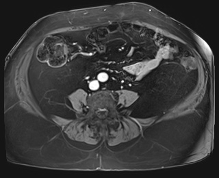 Adrenal cortical carcinoma (Radiopaedia 64017-72770 J 70).jpg