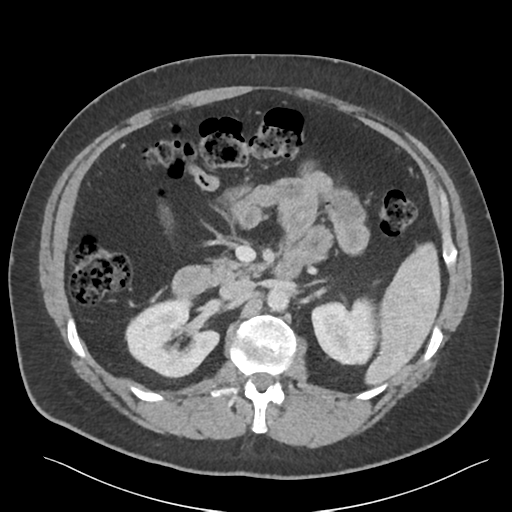 File:Adrenal cyst (Radiopaedia 45625-49777 Axial C+ portal venous phase 42).png