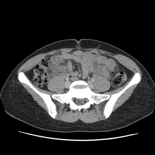 Adrenal cyst (Radiopaedia 64869-73813 Axial C+ portal venous phase 53).jpg