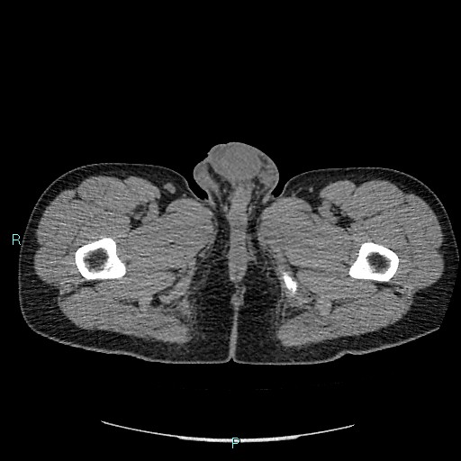 Adrenal cystic lymphangioma (Radiopaedia 83161-97534 Axial non-contrast 113).jpg