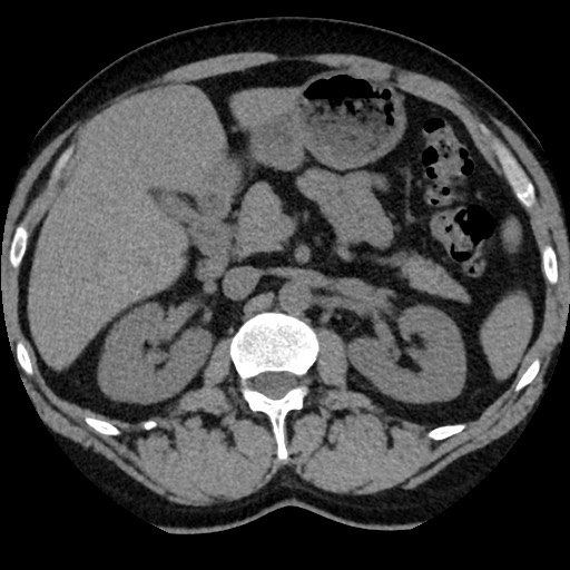File:Adrenal gland trauma (Radiopaedia 81351-95079 Axial non-contrast 40).jpg