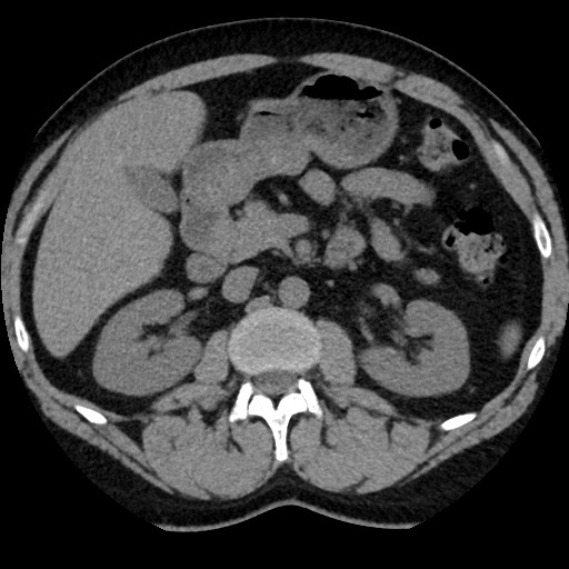 Adrenal gland trauma (Radiopaedia 81351-95079 Axial non-contrast 43).jpg