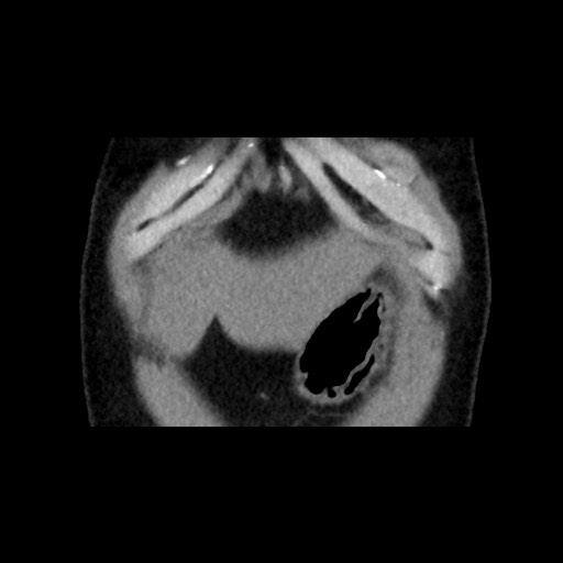 Adrenal gland trauma (Radiopaedia 81351-95079 Coronal non-contrast 14).jpg