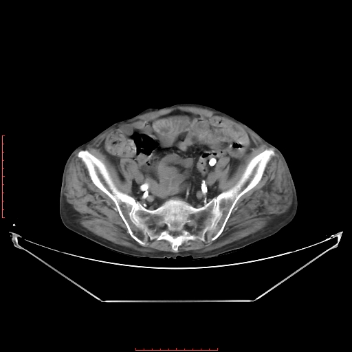 Adrenal hemangioma (Radiopaedia 68923-78668 Axial C+ arterial phase 58).jpg