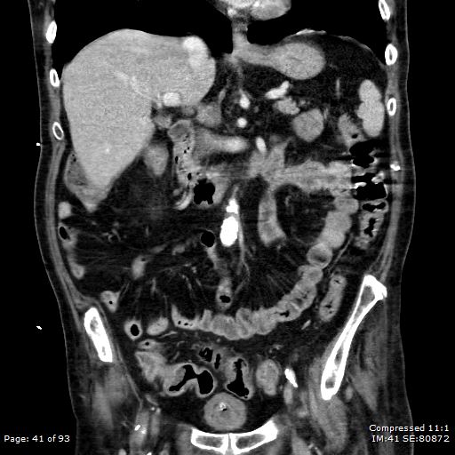 Adrenal metastasis (Radiopaedia 78425-91079 Sagittal C+ portal venous phase 28).jpg