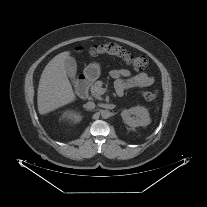Adrenal myelolipoma (Radiopaedia 26278-26407 Axial non-contrast 23).jpg