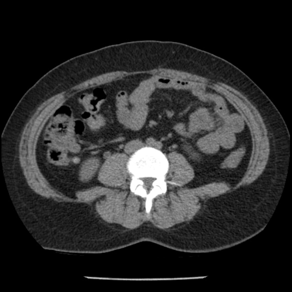 Adrenal myelolipoma (Radiopaedia 43401-46759 Axial non-contrast 49).jpg