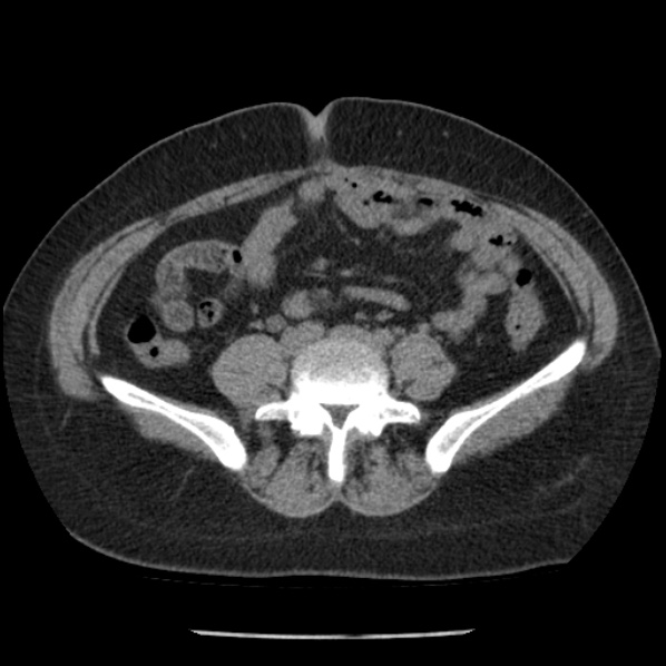 Adrenal myelolipoma (Radiopaedia 43401-46759 Axial non-contrast 57).jpg