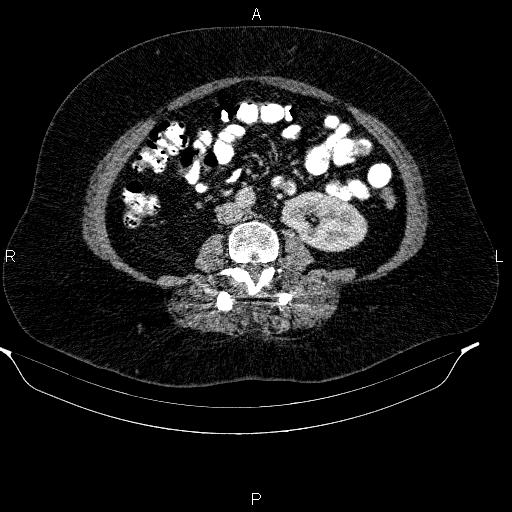 Adrenal myelolipoma (Radiopaedia 84319-99617 Axial renal cortical phase 63).jpg