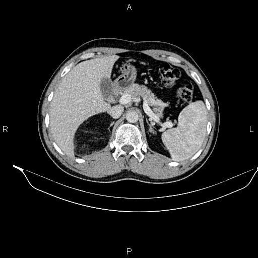 Adrenal myelolipoma (Radiopaedia 87794-104246 Axial renal cortical phase 30).jpg