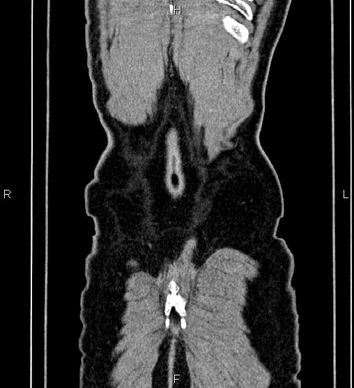 File:Adrenal myelolipoma (Radiopaedia 87794-104246 Coronal renal cortical phase 67).jpg