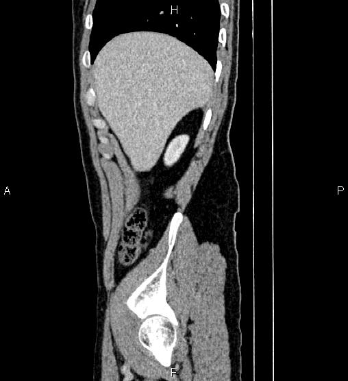 Adrenal myelolipoma (Radiopaedia 87794-104246 Sagittal renal cortical phase 14).jpg