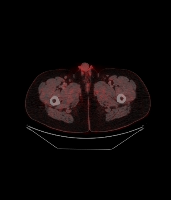 Adrenocortical carcinoma (Radiopaedia 80134-93440 ِAxial 271).jpg