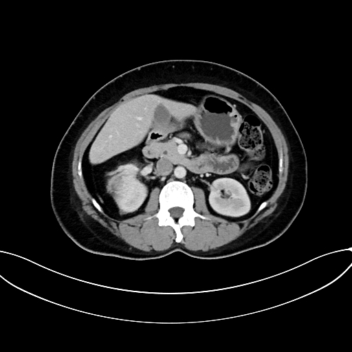 Adrenocortical carcinoma (Radiopaedia 87281-103569 Axial C+ portal venous phase 38).jpg