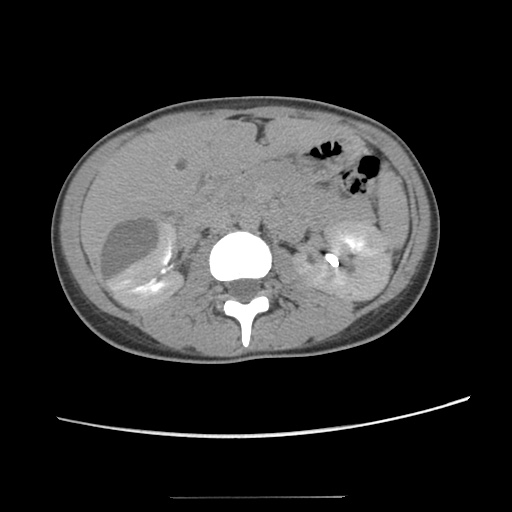 Adult polycystic kidney disease (Radiopaedia 48845-53876 Axial renal excretory phase 39).jpg