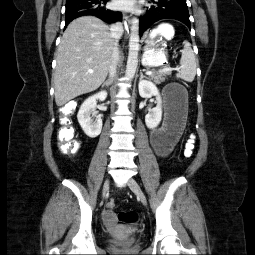 File:Afferent loop syndrome - secondary to incarcerated trocar site hernia (Radiopaedia 82959-97305 Coronal C+ portal venous phase 94).jpg