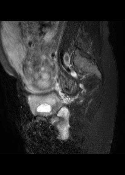 File:Aggressive angiomyxoma of the pelvis and perineum (Radiopaedia 59162-66479 Sagittal T2 fat sat 6).jpg