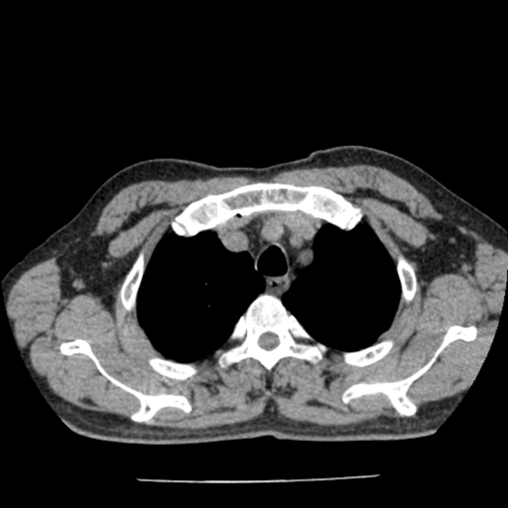 Airway foreign body in adult (Radiopaedia 85907-101779 Axial liver window 13).jpg