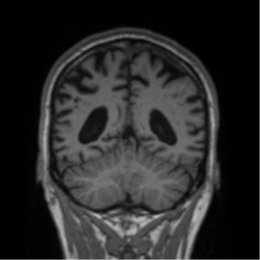 Alzheimer's disease- with Gerstmann syndrome and dressing apraxia (Radiopaedia 54882-61150 Coronal T1 27).png