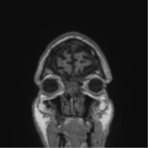File:Alzheimer's disease- with Gerstmann syndrome and dressing apraxia (Radiopaedia 54882-61150 Coronal T1 85).png