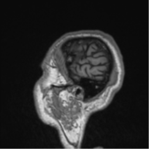 Alzheimer's disease- with Gerstmann syndrome and dressing apraxia (Radiopaedia 54882-61150 Sagittal T1 4).png