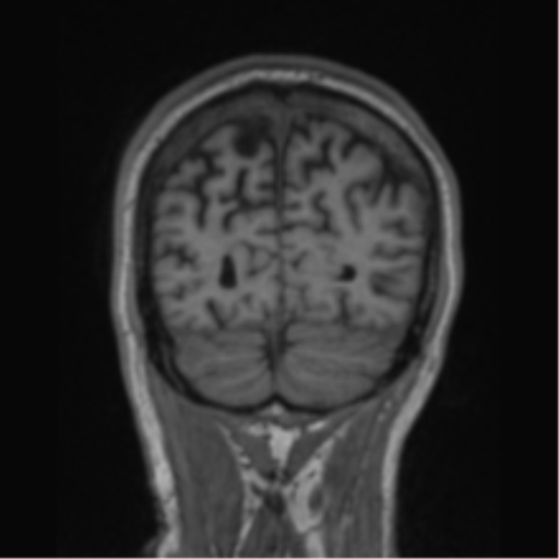 File:Alzheimer's disease- with apraxia (Radiopaedia 54763-61011 Coronal T1 21).png
