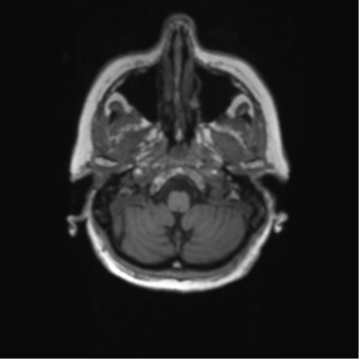 File:Alzheimer's disease (Radiopaedia 42658-45802 Axial T1 130).png