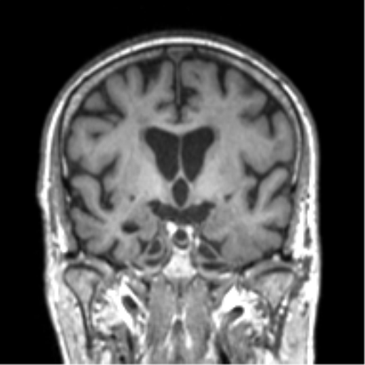 File:Alzheimer disease and cerebral amyloid angiopathy (Radiopaedia 64234-73011 Coronal T1 38).png