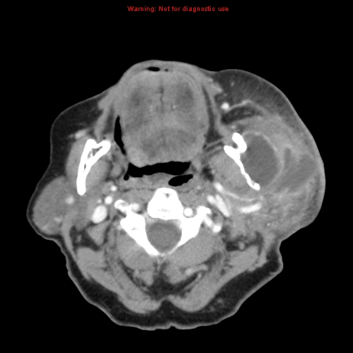 Ameloblastoma (Radiopaedia 27437-27631 A 36).jpg
