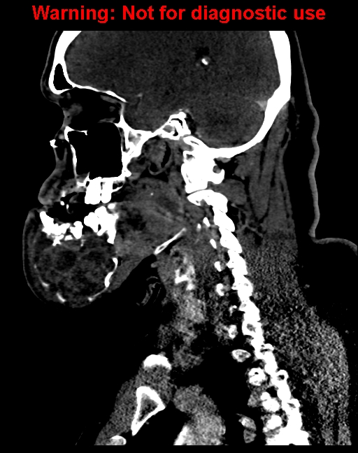 Ameloblastoma (Radiopaedia 33126-34164 F 44).jpg