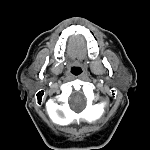Ameloblastoma (Radiopaedia 38520-40623 Axial non-contrast 22).png