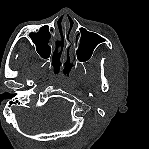 Ameloblastoma (Radiopaedia 51921-57766 Axial bone window 136).jpg