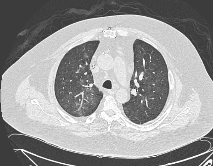 Amiodarone lung (Radiopaedia 62514-70769 Axial lung window 31).jpg