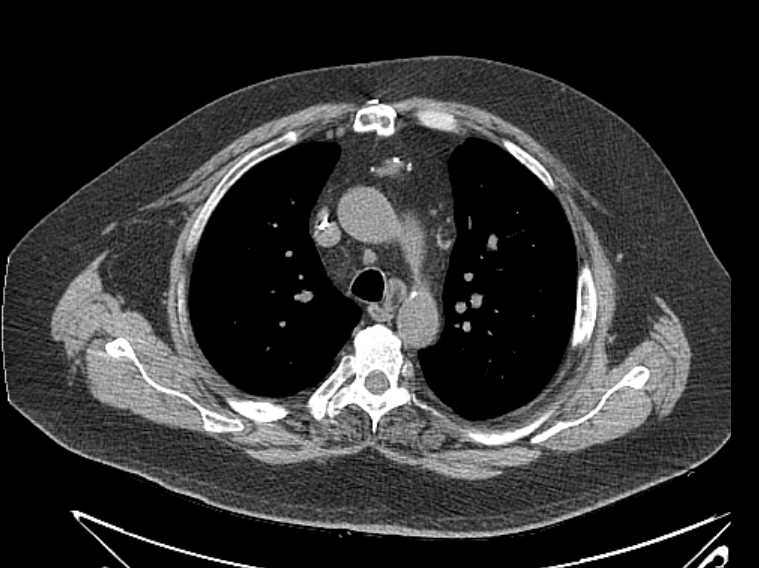 Amiodarone lung (Radiopaedia 62514-70769 Axial non-contrast 29).jpg