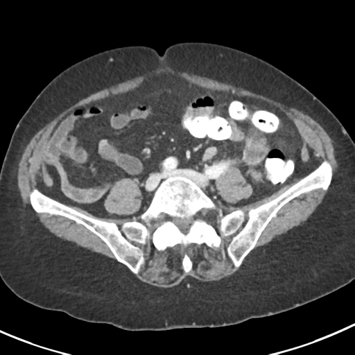 Ampullary adenocarcinoma (Radiopaedia 34013-35237 C 35).png
