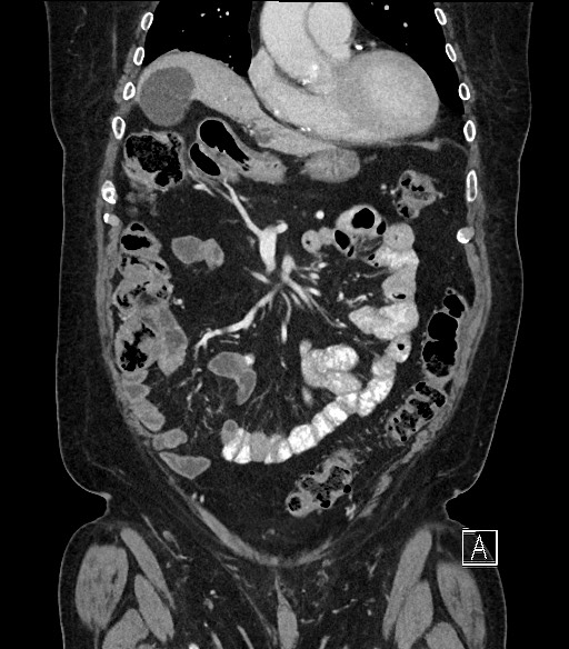 Ampullary adenocarcinoma (Radiopaedia 59373-66734 D 28).jpg