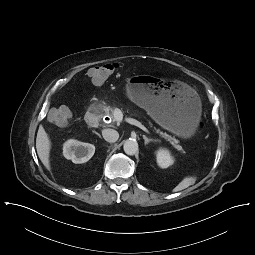 Ampullary adenocarcinoma (Radiopaedia 59373-66737 A 58).jpg