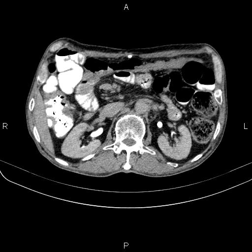 Ampullary adenocarcinoma (Radiopaedia 86093-102033 Axial C+ delayed 48).jpg
