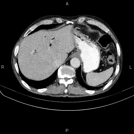 Ampullary adenocarcinoma (Radiopaedia 86093-102033 B 50).jpg