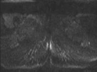 Anal adenocarcinoma - tumor regression grade 1 (Radiopaedia 31358-32100 Axial DWI 2).jpg