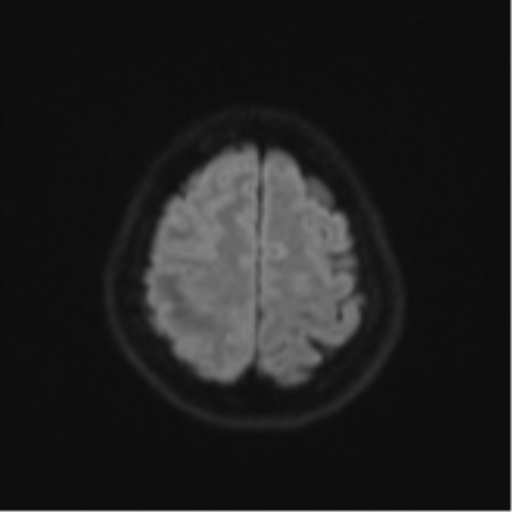 Anaplastic astroblastoma (Radiopaedia 55666-62194 Axial DWI 52).png