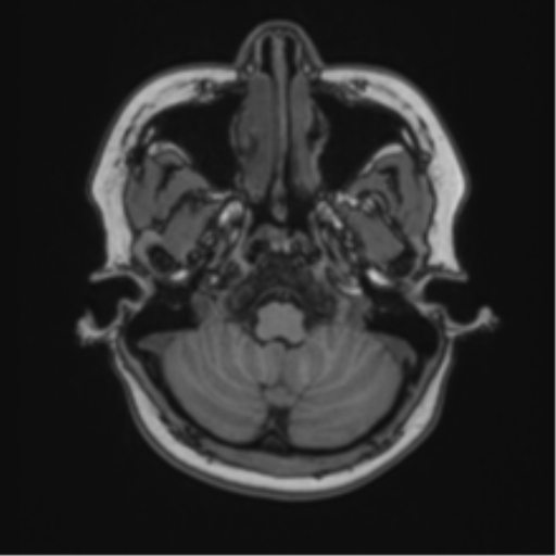Anaplastic astroblastoma (Radiopaedia 55666-62194 Axial T1 13).png