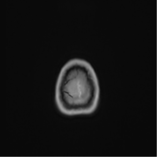 Anaplastic astroblastoma (Radiopaedia 55666-62194 Axial T1 C+ 75).png